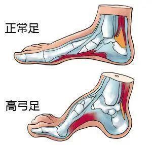 骨科医生提醒：千万别陷入这买鞋5大误区  五步选鞋法、正确量脚长方法