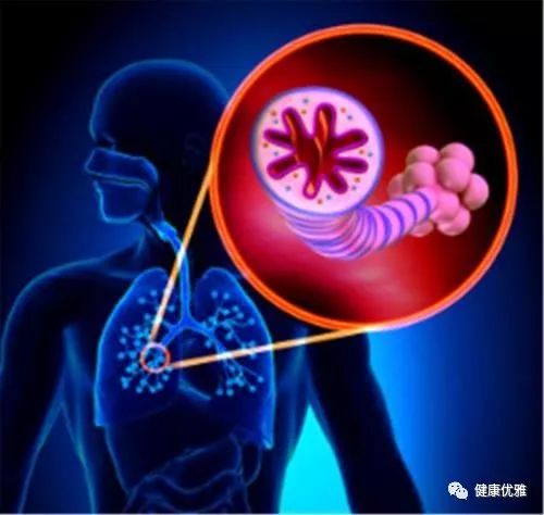 支气管扩张可以做扩胸运动吗_支气管扩张能练气功吗_支气管扩张能健身吗