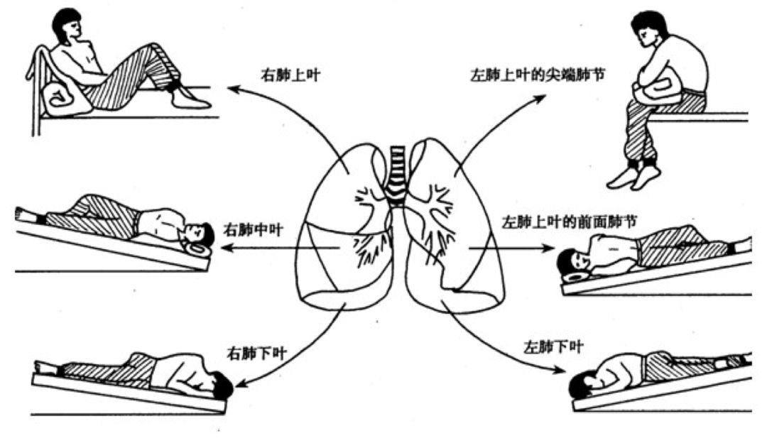 支气管扩张通过锻炼能好吗_支气管扩张可以健身吗_支气管扩张能健身吗